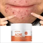 Herbal Acne Treatment Cream Anti Acne Face Cream Pimple Removal Spots Oil Control Shrink Pores Moisturizing Skin Care Cream